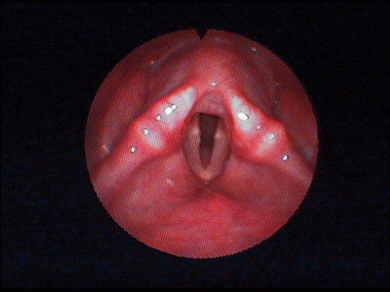 Fibro Nasofaringolaringoscopio Flexível Machida Modelo ENT-30PC